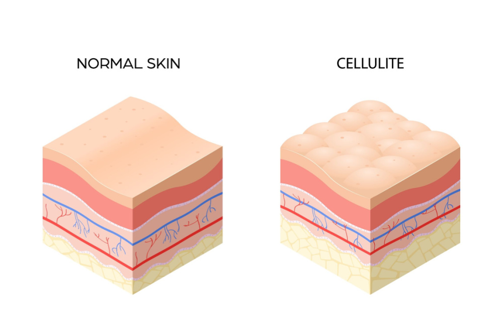 cellulite versus normal skin