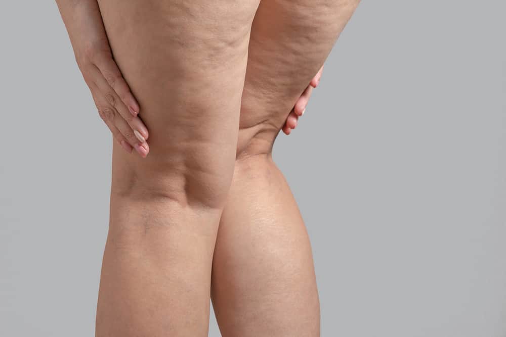 cellulite in legs