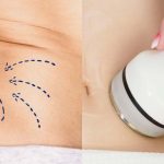 liposuction versus non surgical banner